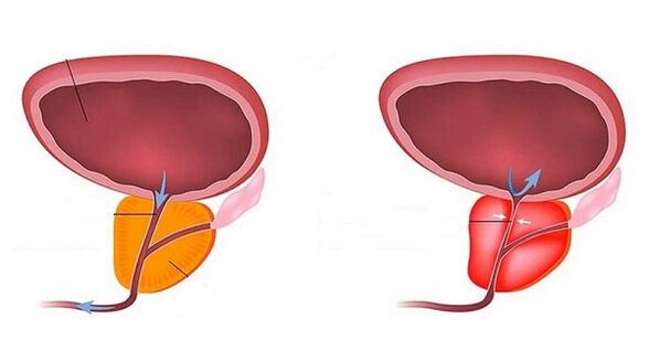 Healthy and inflamed prostate prostatitis